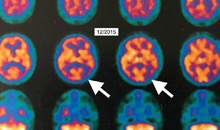 HBOT ha mostrato un miglioramento nella malattia di Alzheimer